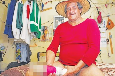 Του έβγαλαν επίδομα ΑμεΑ λόγω του xxl πέους του!