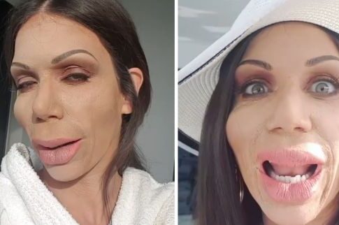 Αγνώριστη από τα botox η Στικούδη