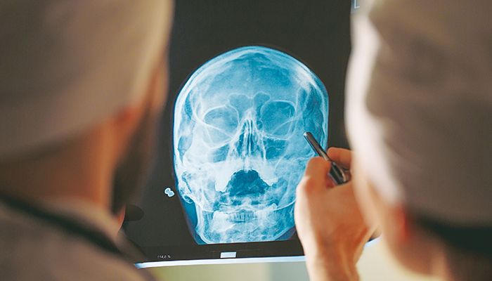 «Έξυπνη» διάγνωση για αδιόρατες εγκεφαλικές αιμορραγίες