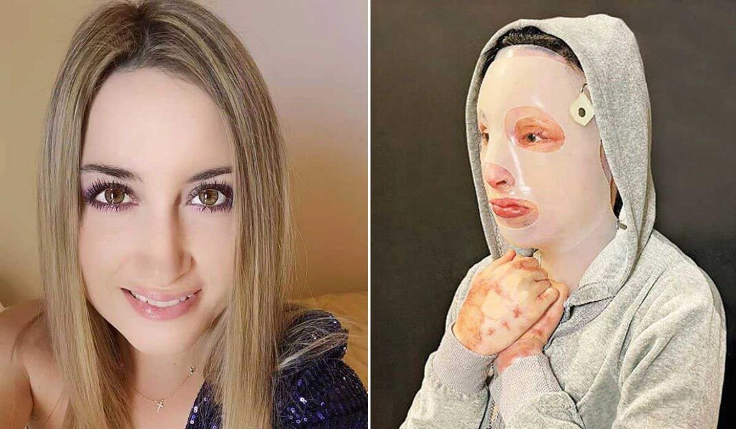 Η Ιωάννα μετά το βιτριόλι! Η φωτογραφία-σοκ της 34χρονης έπειτα από 10 χειρουργεία!