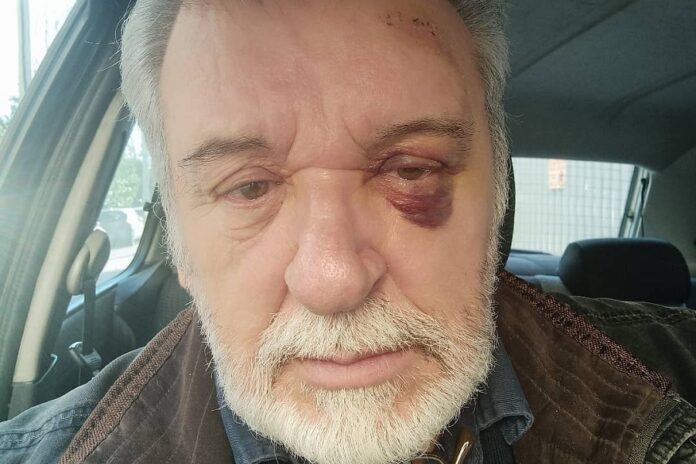 Ο Τάσος Χαλκιάς τραυματίστηκε σοβαρά στο μάτι - Το μήνυμά του