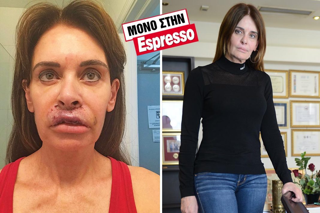 Kατερίνα Πλουμιδάκη: Ο εφιάλτης στα χέρια γνωστού πλαστικού χειρουργού