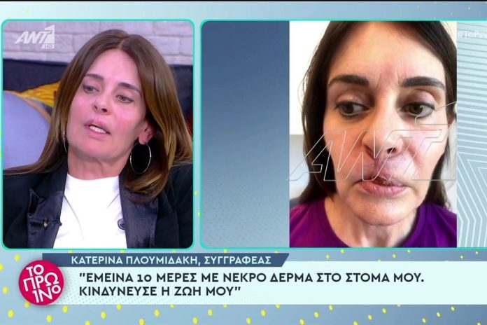 Συγκλονίζει η Κατερίνα Πλουμιδάκη μετά την αποτυχημένη πλαστική επέμβαση: «Σκεφτόμουν να αυτοκτονήσω»